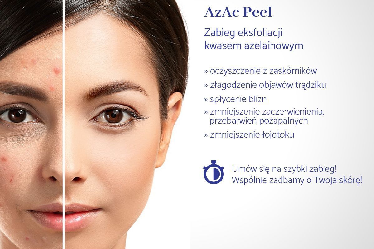 Portfolio usługi AzAc Peel - Zabieg eksfoliacji kwasem azelainowym