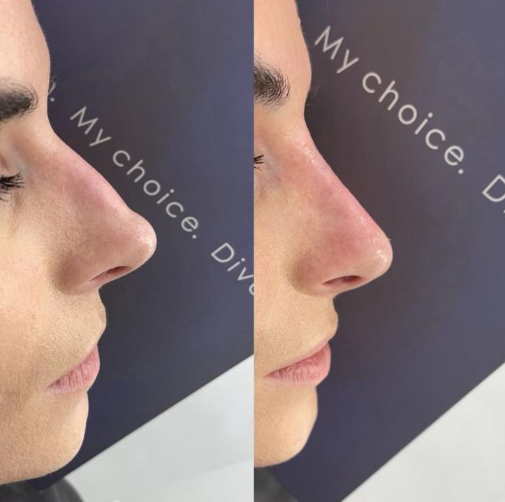 Portfolio usługi Modelowanie nosa