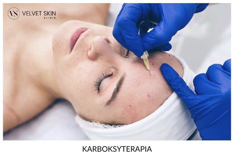 Portfolio usługi Karboksyterapia twarzy, szyi i dekoltu