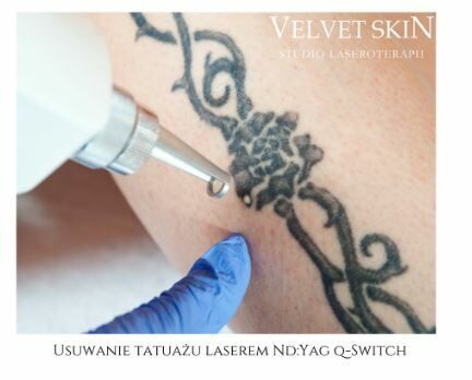 Portfolio usługi Laserowe usuwanie tatuażu czarnego