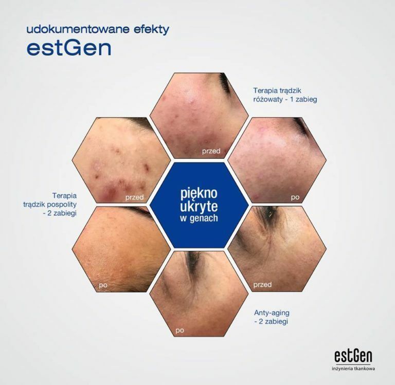 Portfolio usługi EstGen kwasy + oczyszczanie wodorowe