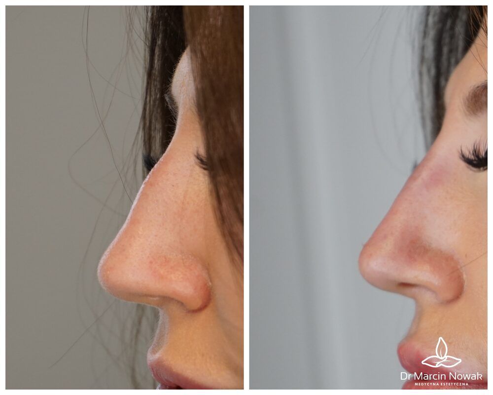Portfolio usługi Kwas hialuronowy - Modelowanie nosa