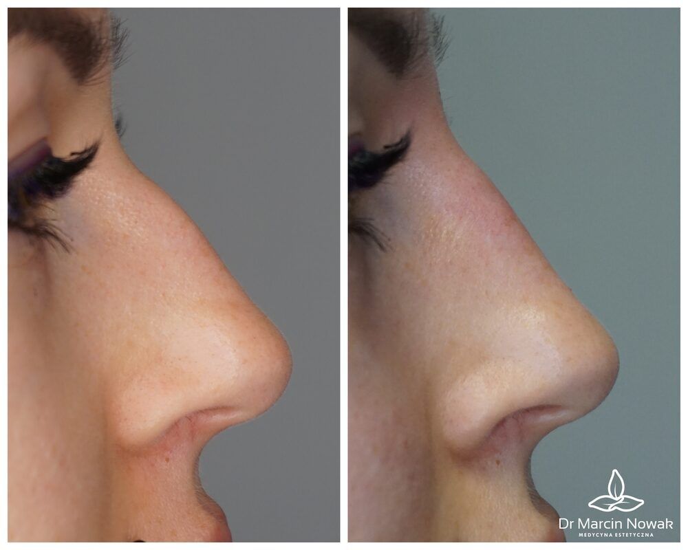 Portfolio usługi Kwas hialuronowy - Modelowanie nosa