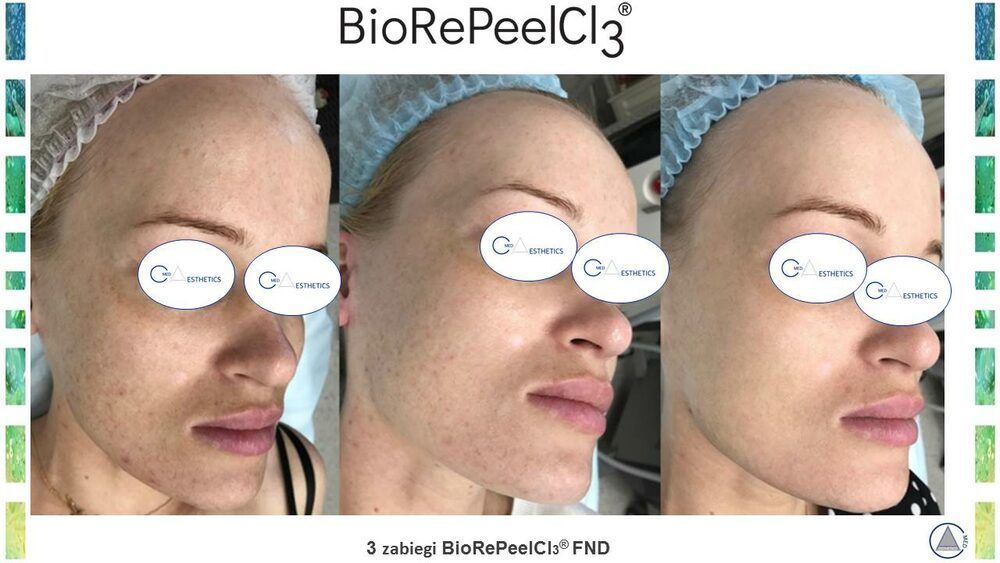 Portfolio usługi BioRePeel (twarz) z mikronakłuwaniem