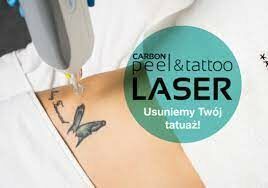 Portfolio usługi Laserowe usuwanie tatuażu