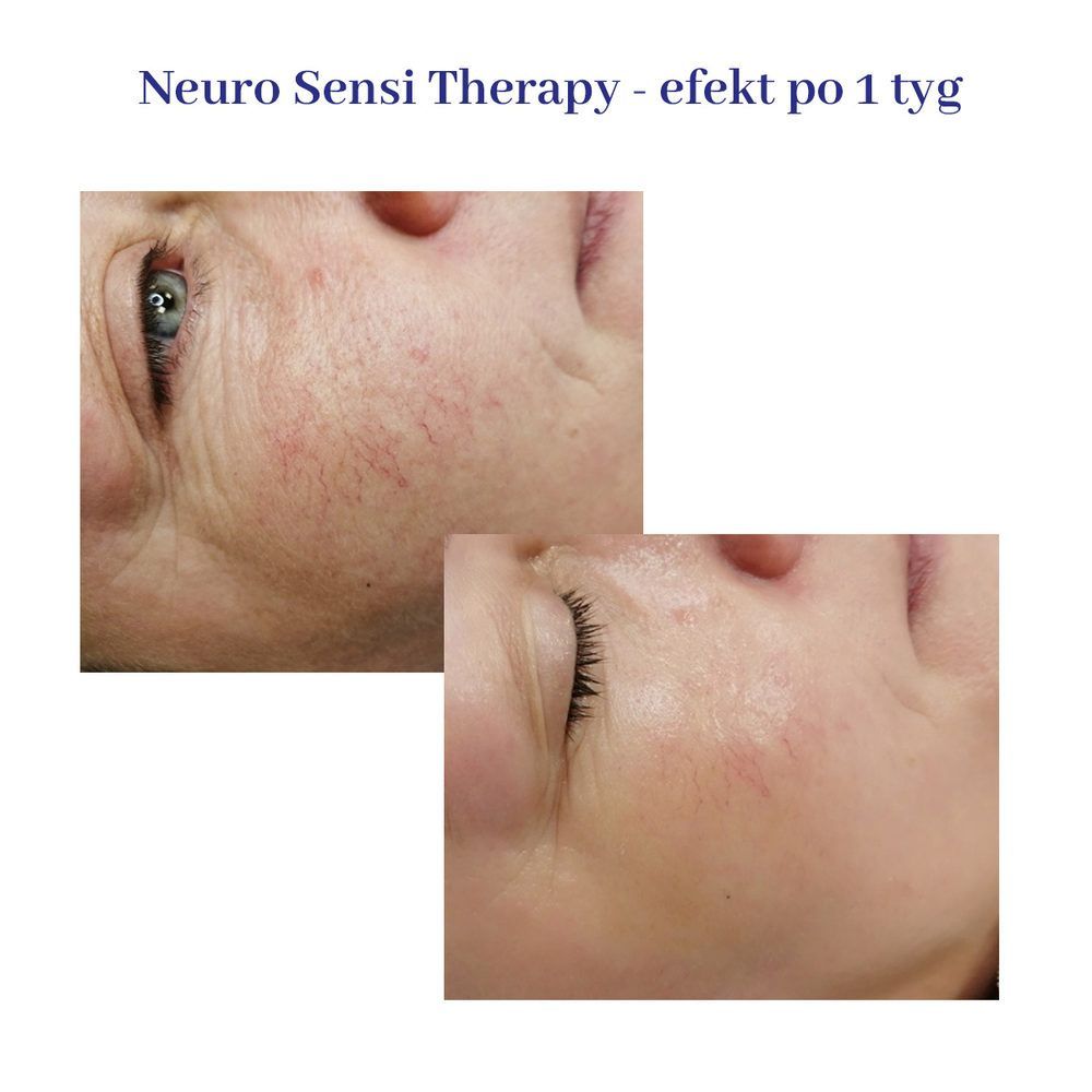 Portfolio usługi Neuro Sensi Therapy- Zabieg eksfoliacji neurose...