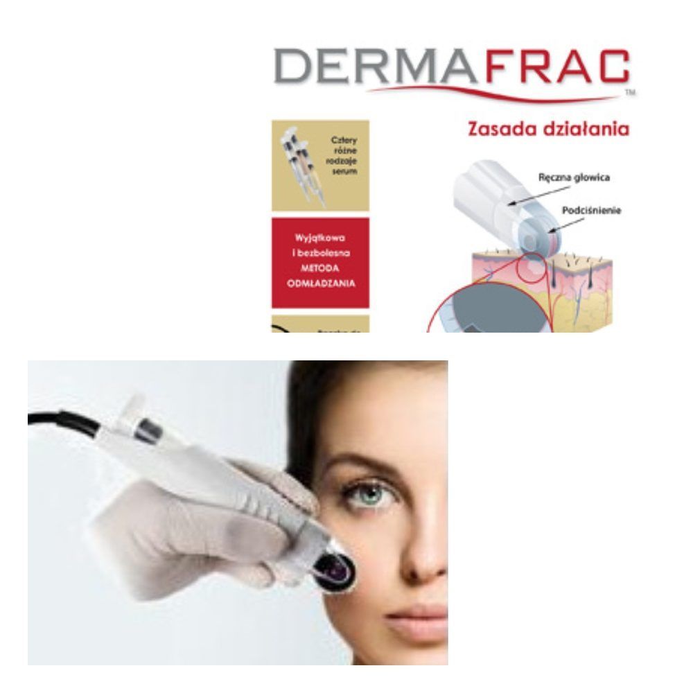 Portfolio usługi DermaFrac (twarz+szyja+dekolt)