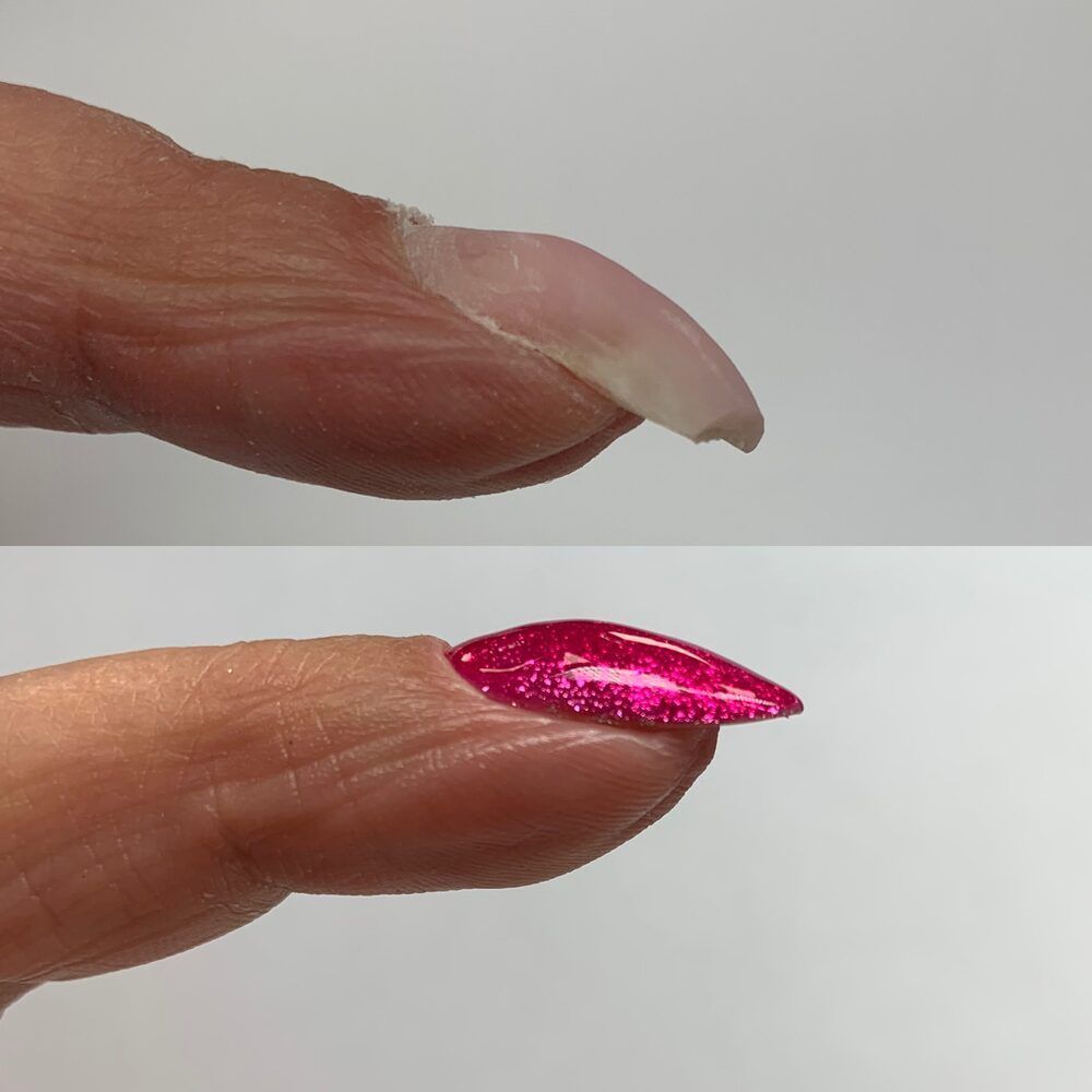 Portfolio usługi Korekta paznokci krogulczych, rosnących w dół