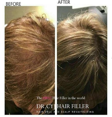 Portfolio usługi DR.CYJ Hair Filler terapia łysienia