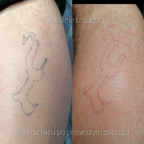 Portfolio usługi laserowe usuwanie tatuażu - średni tatuaż 5-25cm2