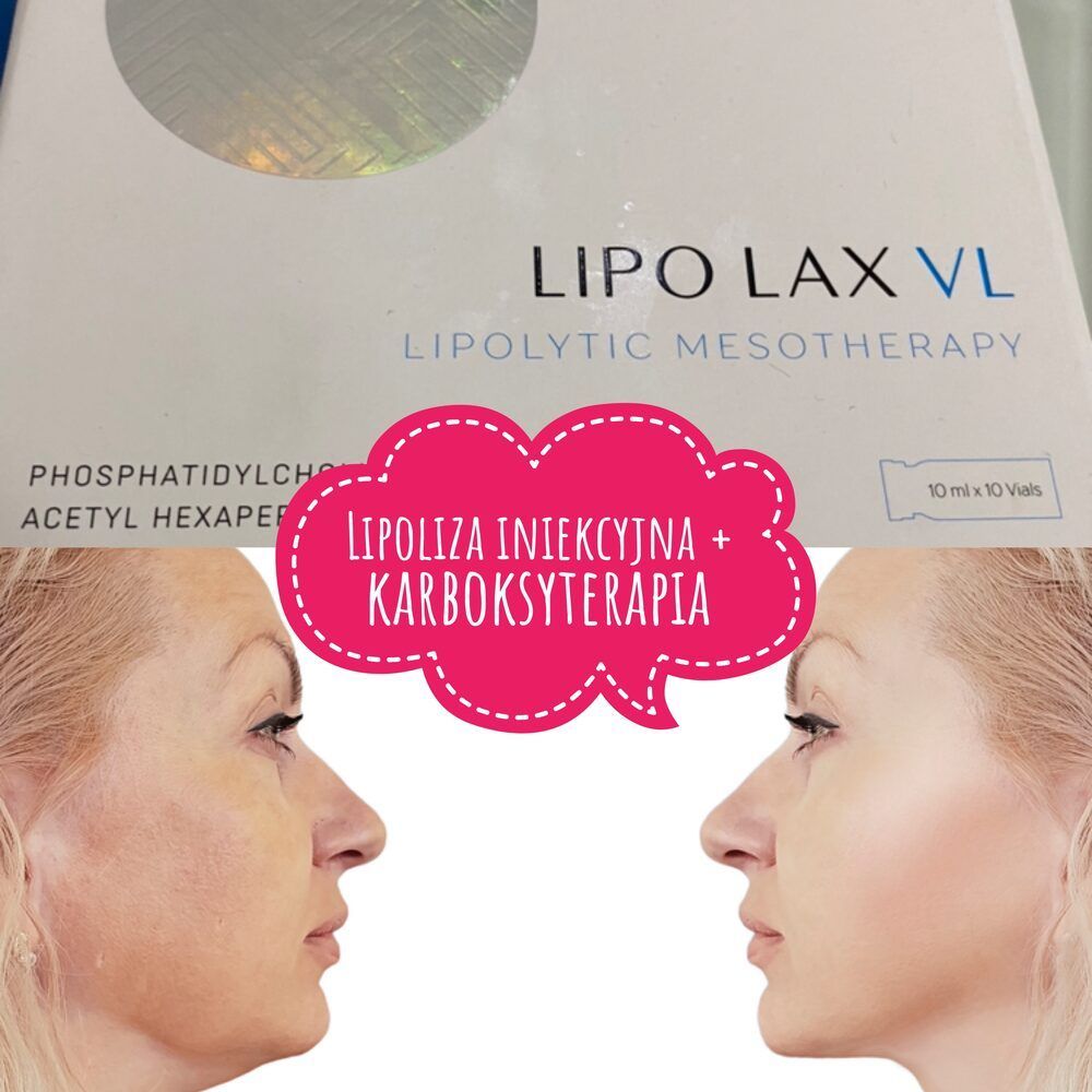 Portfolio usługi Lipoliza iniekcyjna - twarz LIPOLAX VL