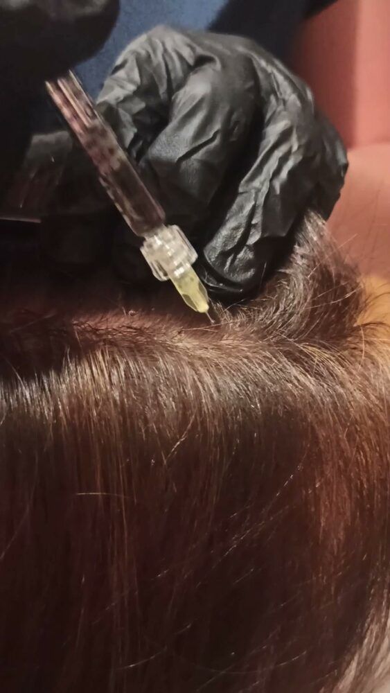 Portfolio usługi Kuracja na porost włosów Dr  Cyj Hair Filler