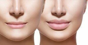 Portfolio usługi Perfect Lips( mezoterapia)
