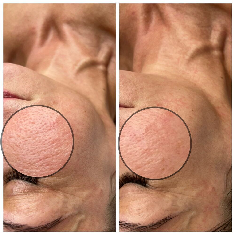 Portfolio usługi Terapia enzymatyczna+oczyszczanie wodorowe twar...