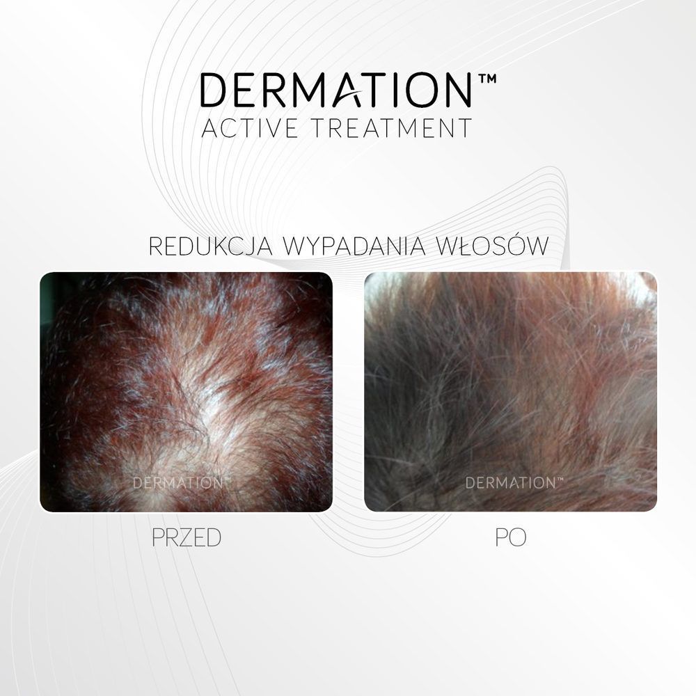 Portfolio usługi Dermation - leczenie łysienia