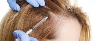 Portfolio usługi Mezoterapia igłowa skóry głowy