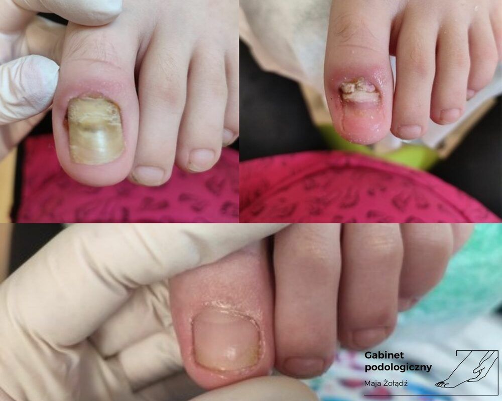 Portfolio usługi Oczyszczenie paznokcia zmienionego chorobowo