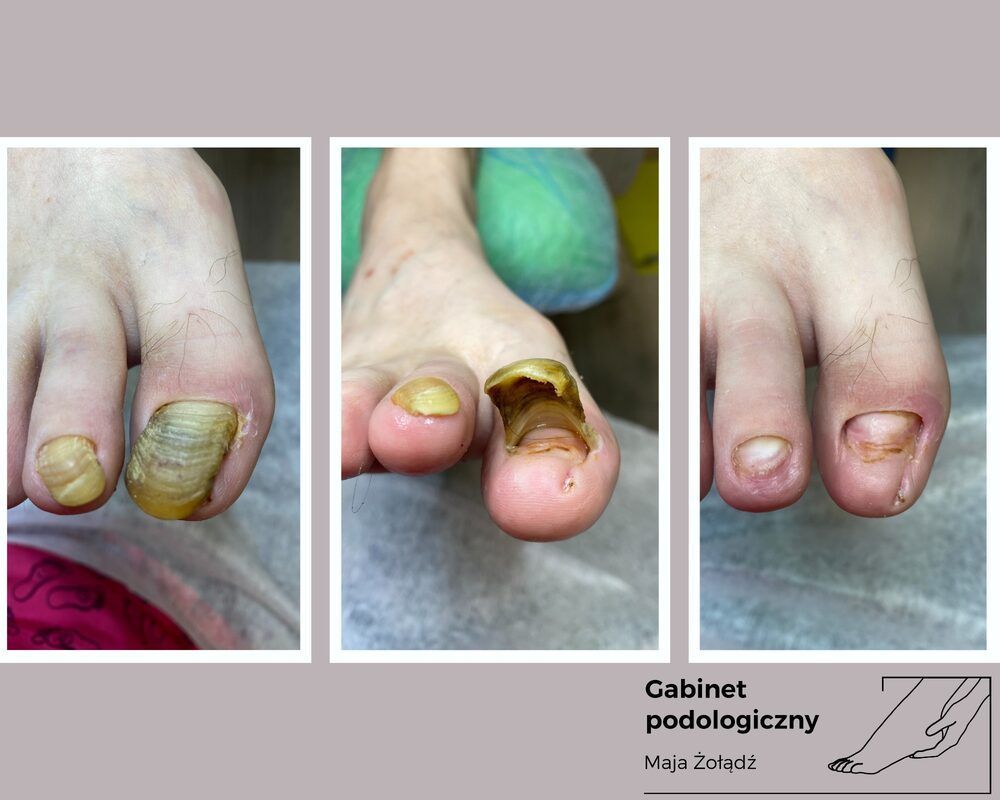 Portfolio usługi Oczyszczenie paznokcia zmienionego chorobowo