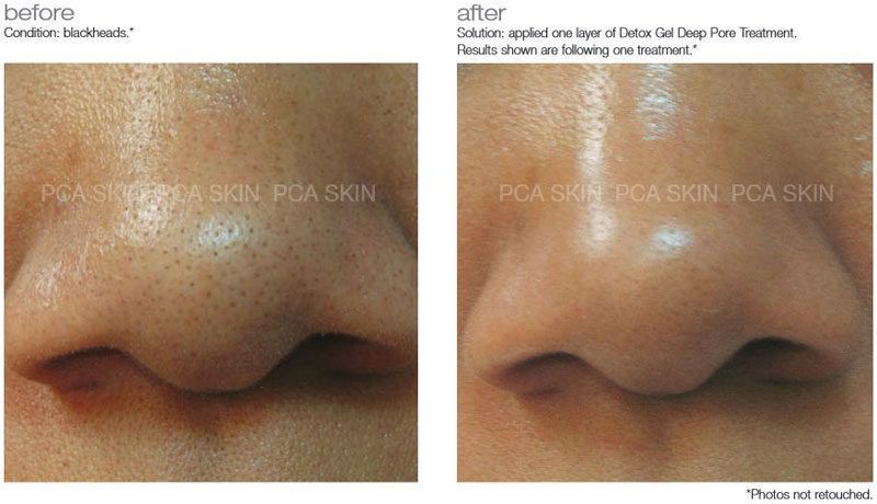 Portfolio usługi Oczyszczanie twarzy - PCA Skin