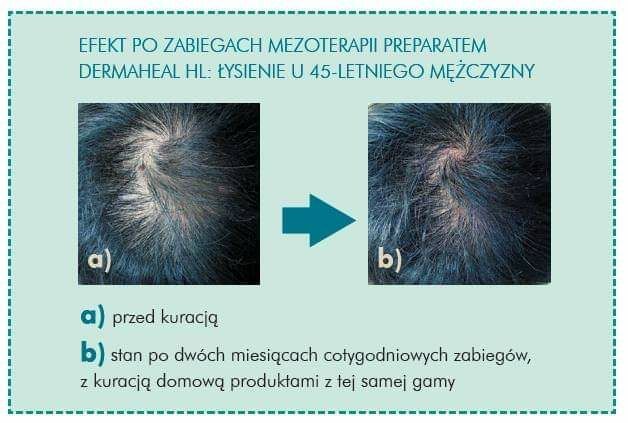 Portfolio usługi Mezoterapia igłowa skóry głowy - terapia wzmacn...