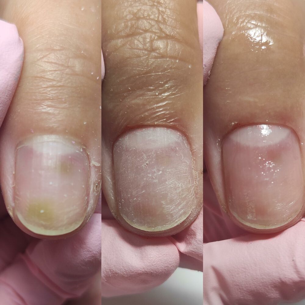 Portfolio usługi Oczyszczenie paznokcia chorobowo zmienionego