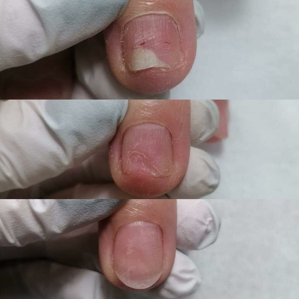 Portfolio usługi Oczyszczenie paznokcia chorobowo zmienionego