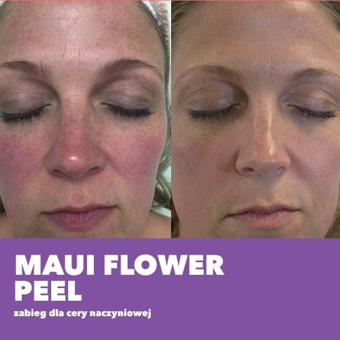 Portfolio usługi Maui Flower Peel 3 zabiegi