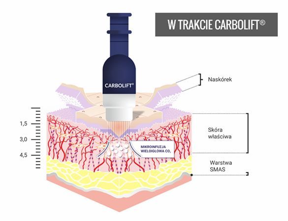 Portfolio usługi CARBOLIFT® – terapia mezoterapii mikroigłowej CO2