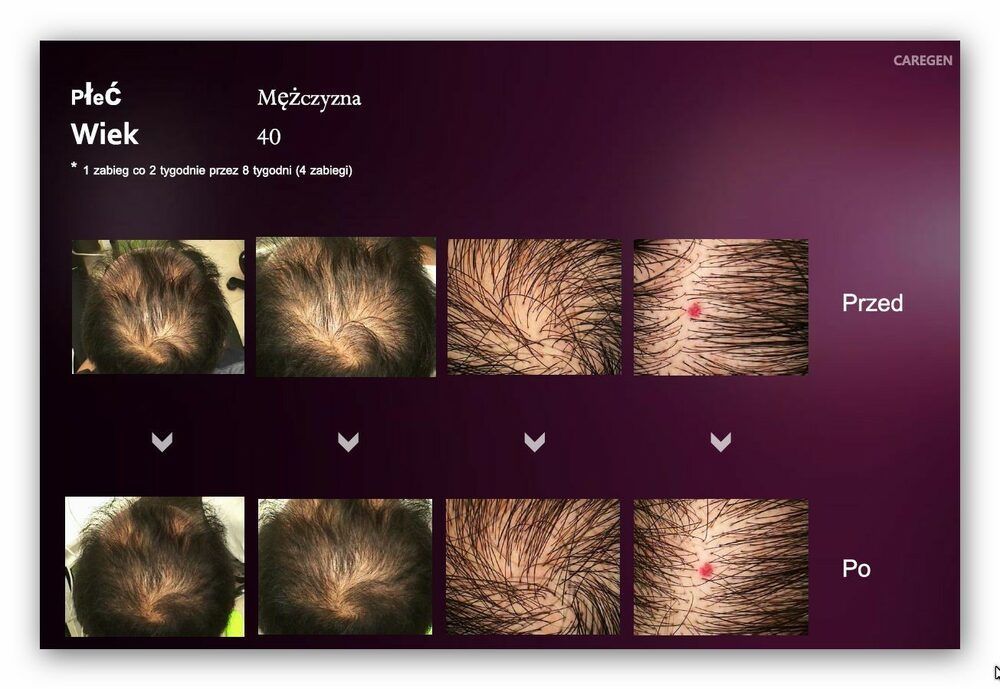 Portfolio usługi Mezoterapia igłowa Hair Filler Dr Cyj