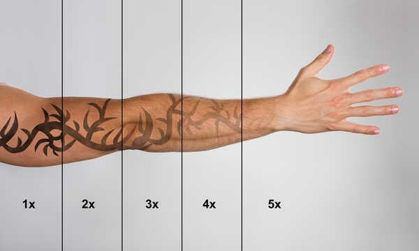 Portfolio usługi Laserowe usuwanie tatuażu (czarny) duży