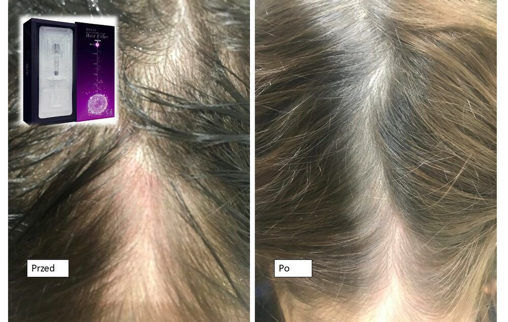 Portfolio usługi Mezoterapia igłowa Hair Filler Dr Cyj