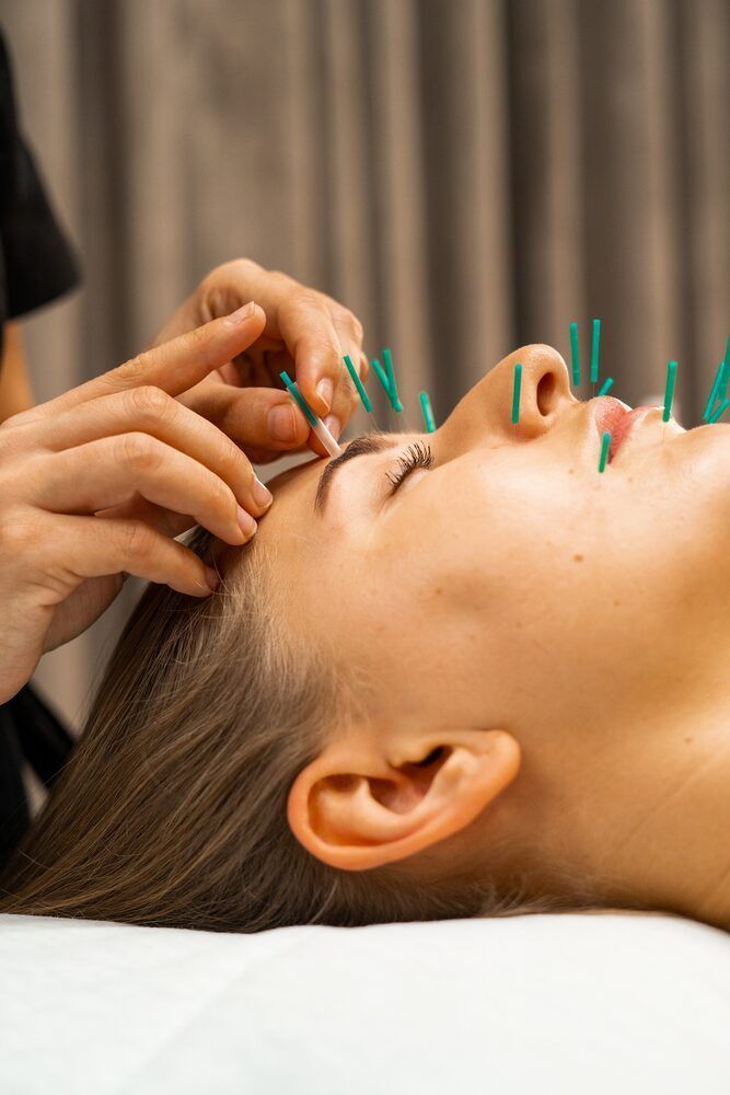 Portfolio usługi Akupunktura kosmetologiczna - 100 punktów piękn...