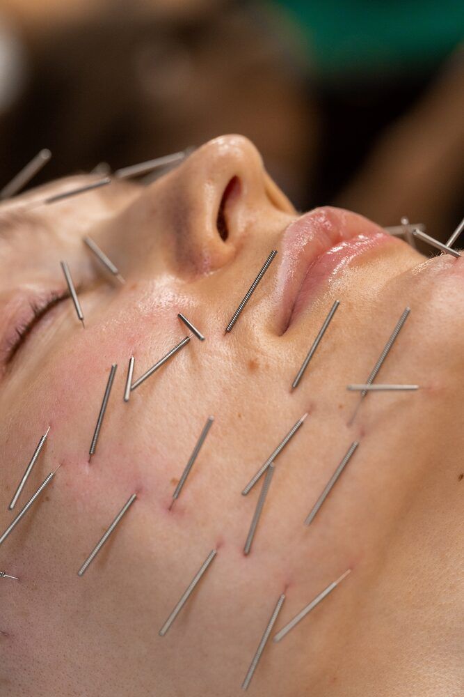 Portfolio usługi Akupunktura Enterodermalna(Lifting z korekcją t...