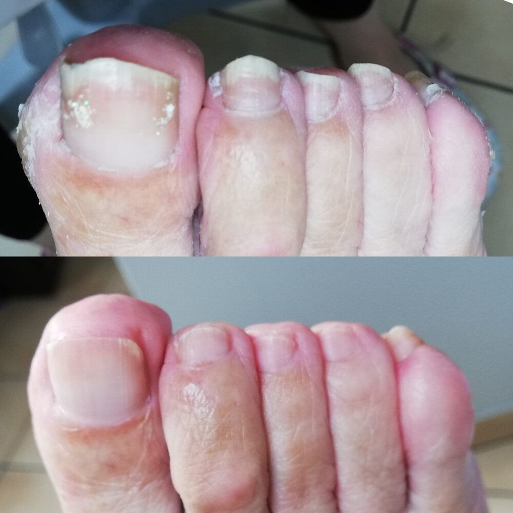 Portfolio usługi Oczyszczenie paznokci zmienionych chorobowo