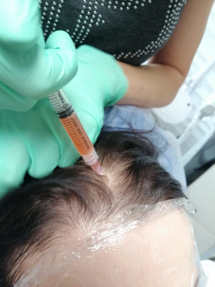 Portfolio usługi osocze bogatopłytkowe skóra głowy (łysienie)