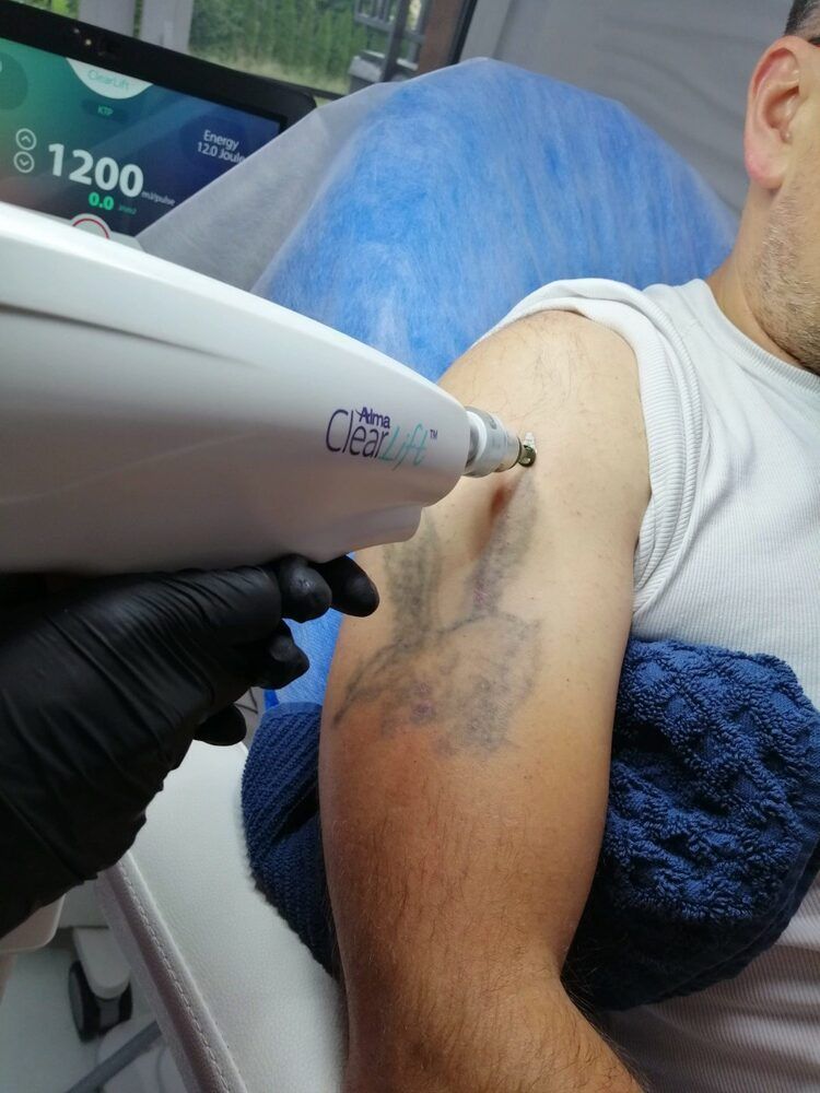 Portfolio usługi usuwanie tatuażu do 10cm2