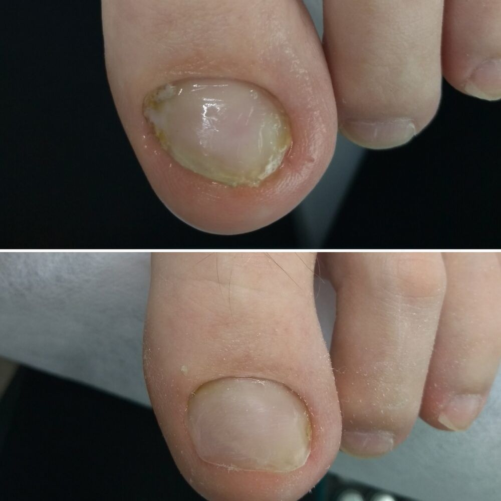 Portfolio usługi Korekta wrastającego paznokcia (2 paznokcie)