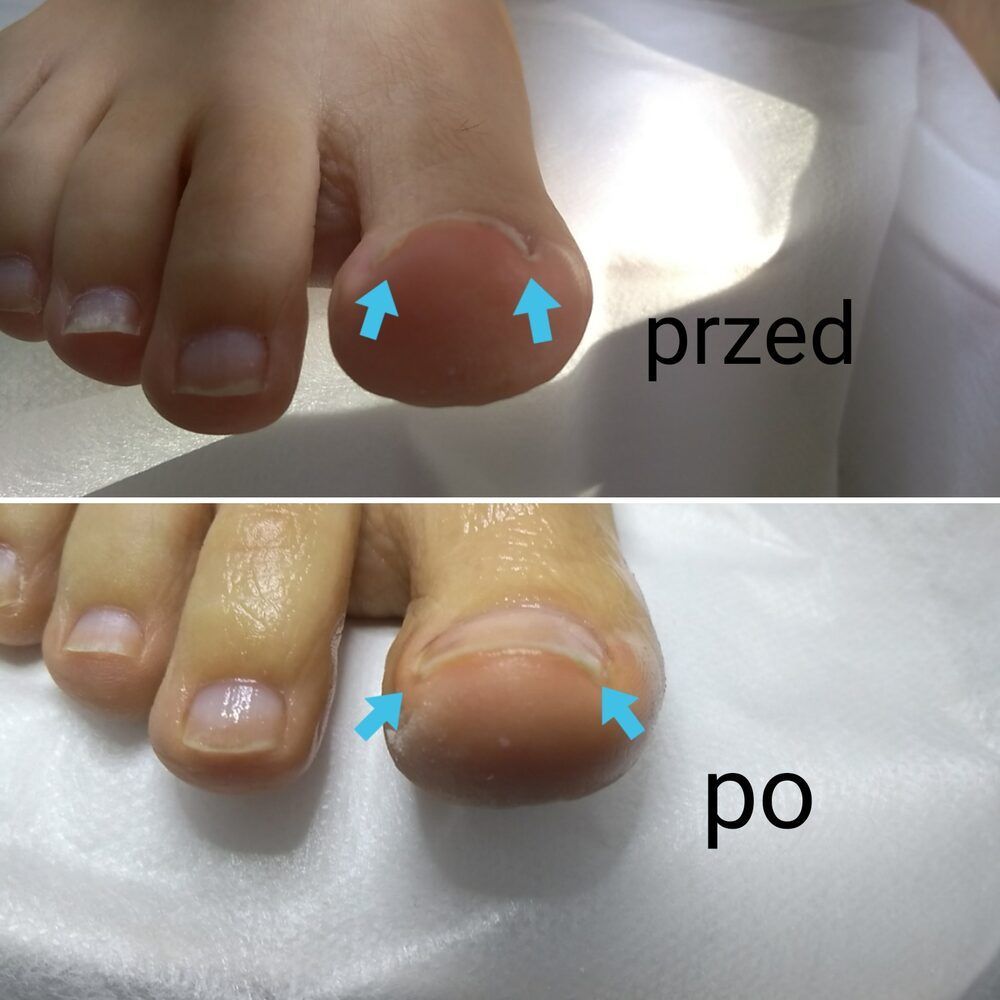 Portfolio usługi Korekta wrastającego paznokcia (1 paznokieć)