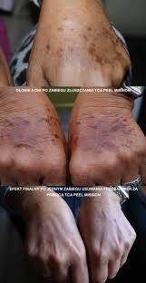 Portfolio usługi Przebudowa skóry dłoni kwasem TCA