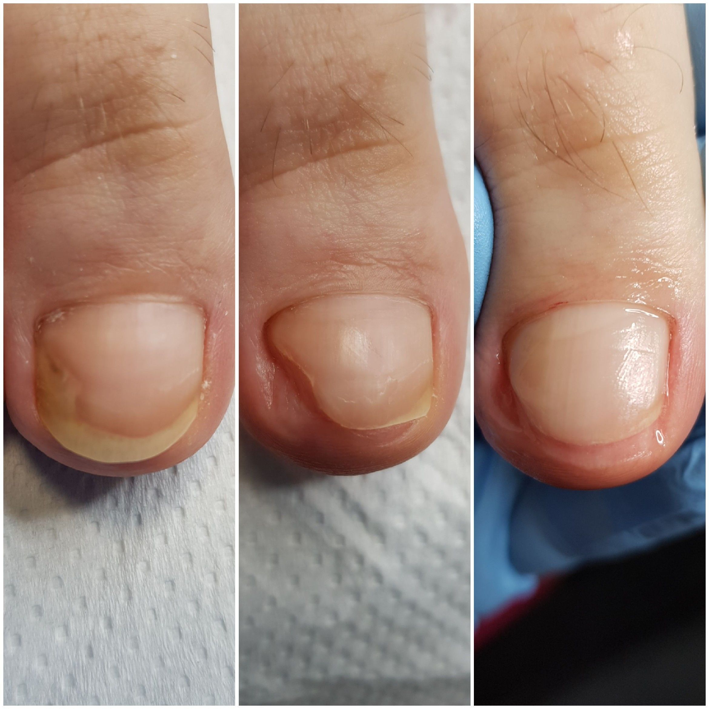 Portfolio usługi Opracowanie zmienionych chorobowo paznokci stóp