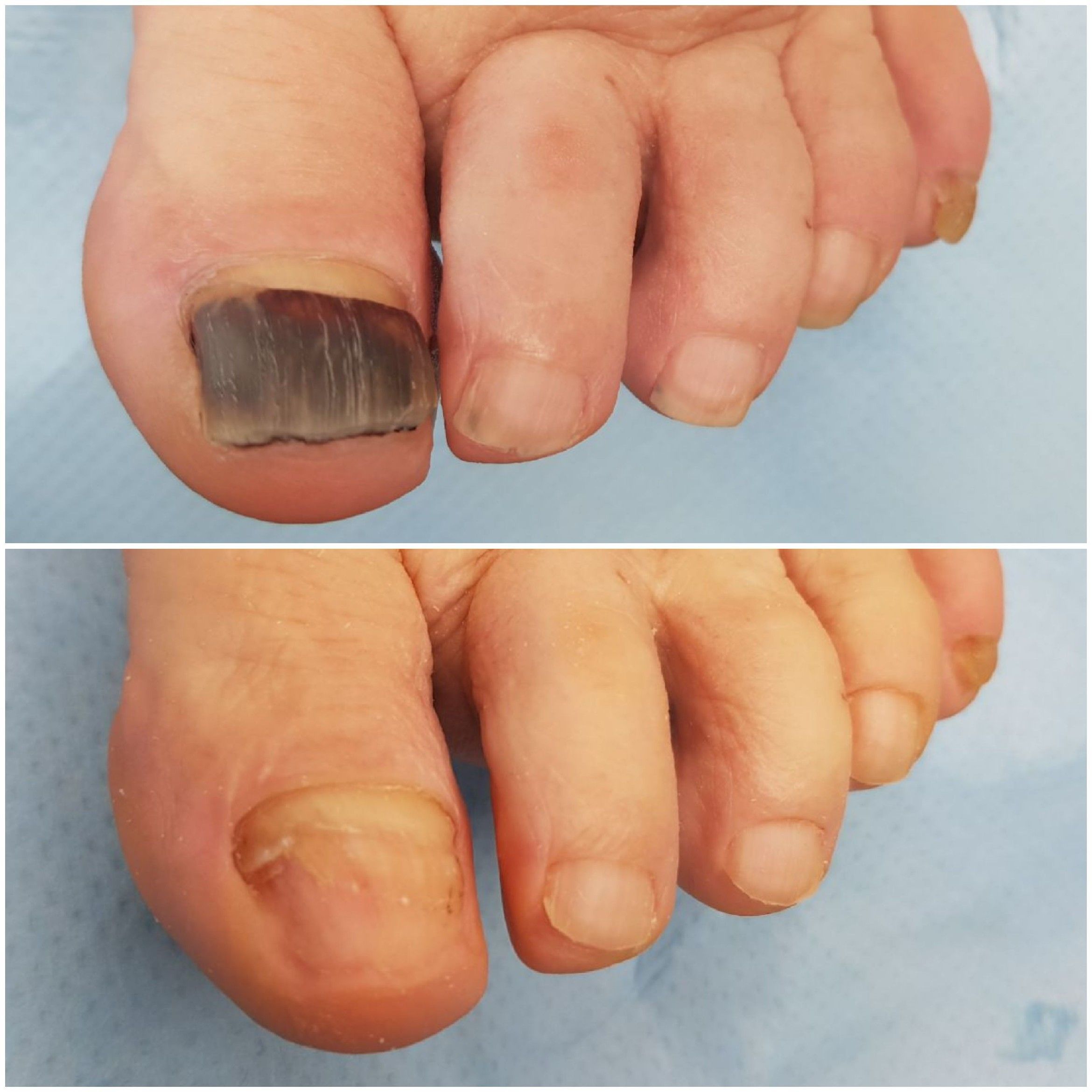 Portfolio usługi Opracowanie zmienionych chorobowo paznokci stóp