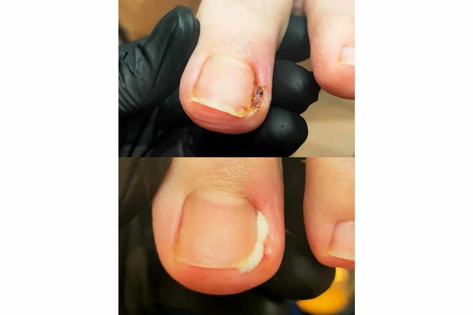 Portfolio usługi Opracowanie wrastających paznokci - 1 paznokieć