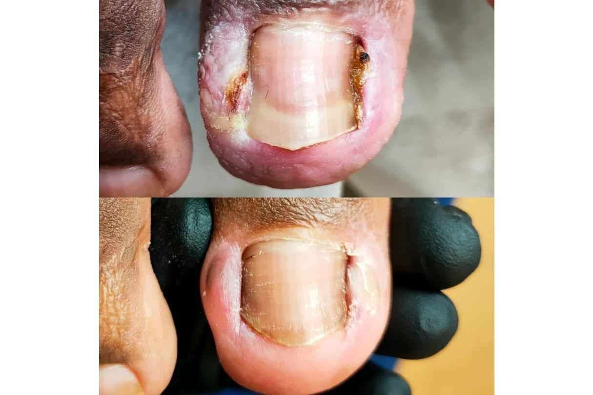 Portfolio usługi Opracowanie wrastających paznokci - 1 paznokieć
