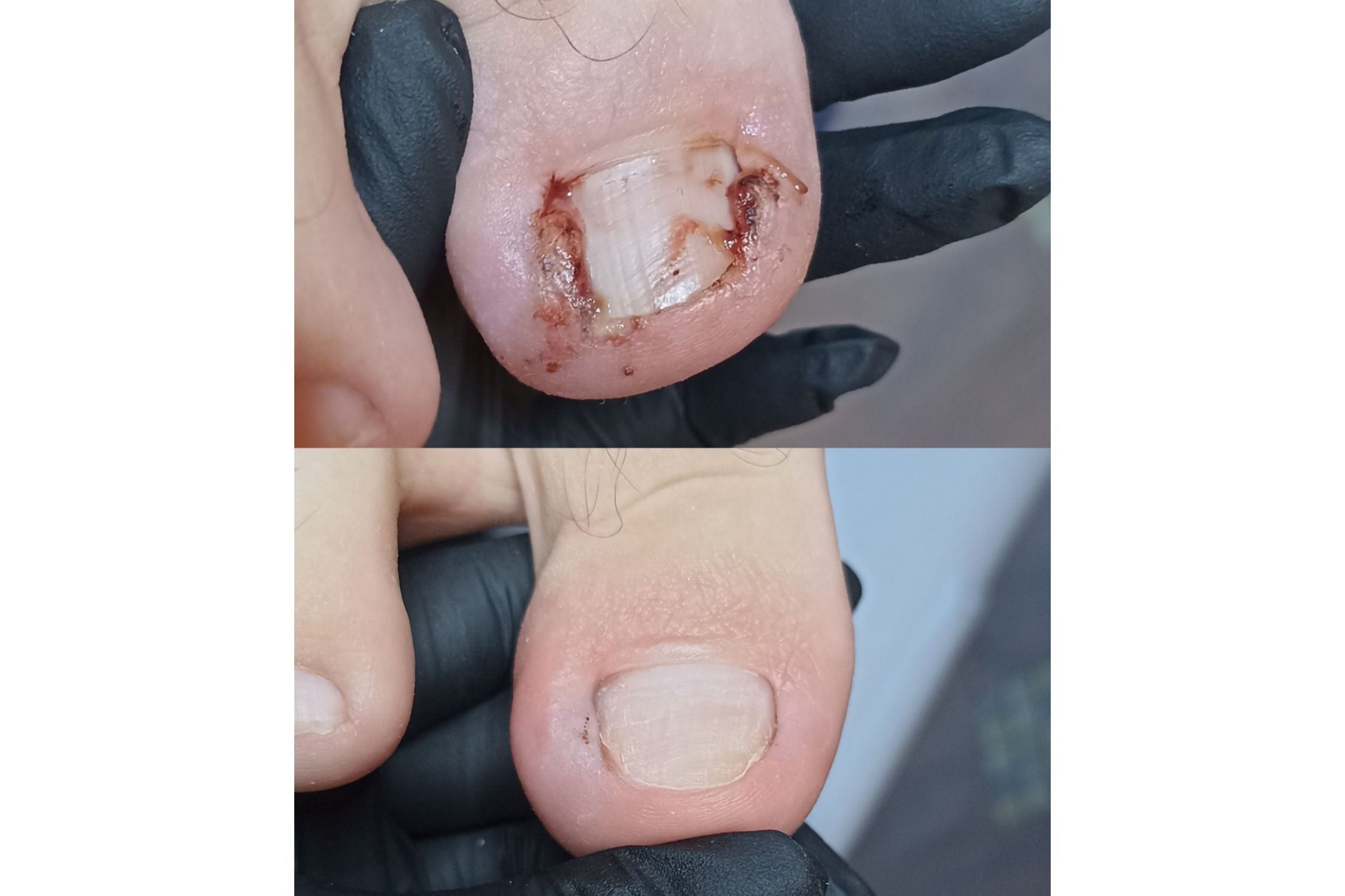 Portfolio usługi Opracowanie wrastających paznokci - 2 paznokcie