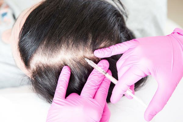Portfolio usługi Karboksyterapia - zabieg na skórę głowy (na włosy)