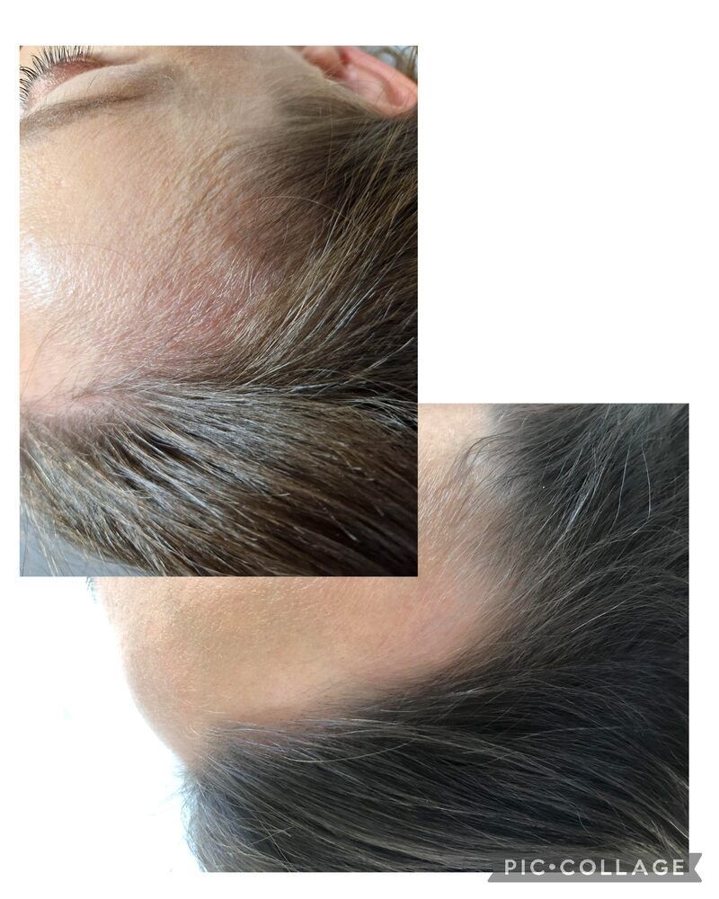 Portfolio usługi Peptydowa terapia skóry głowy