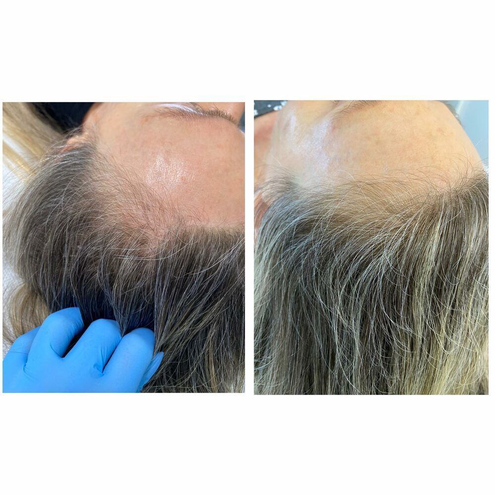 Portfolio usługi Dr. Cyj Hair Filler/ Peptydowa terapia skóry głowy
