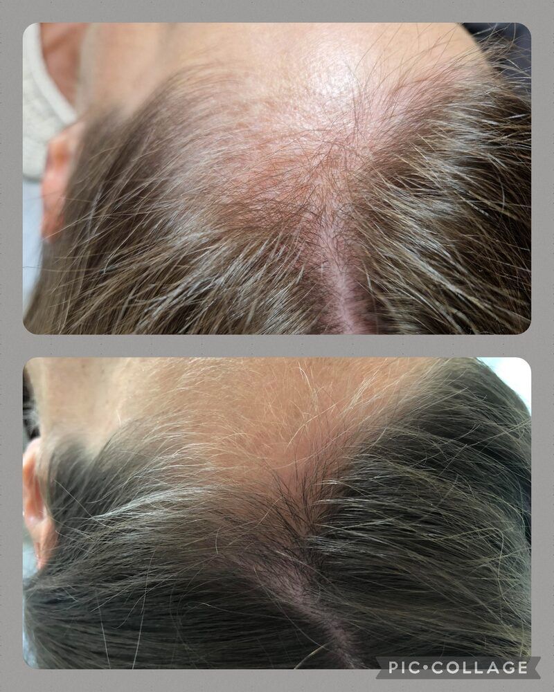 Portfolio usługi Dr. Cyj Hair Filler/ Peptydowa terapia skóry głowy