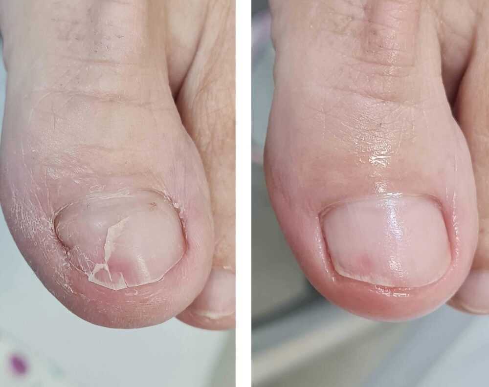 Portfolio usługi Oczyszczenie paznokcia pourazowego (onycholiza,...