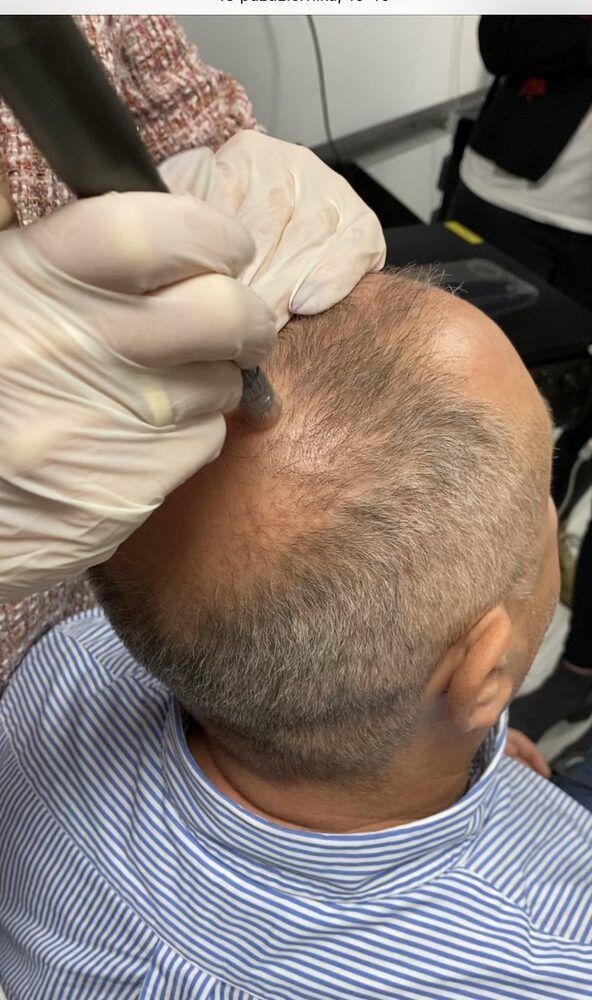 Portfolio usługi mezoterapia mikroigłowa skóry głowy